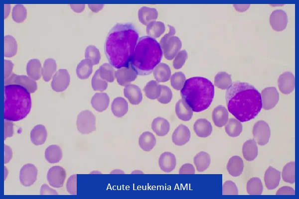 Acute Leukemia AML
