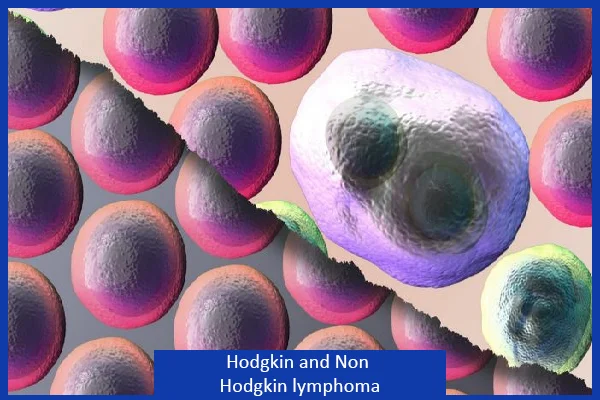 Hodgkin and Non Hodgkin lymphoma
