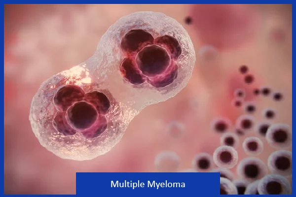 Multiple Myeloma