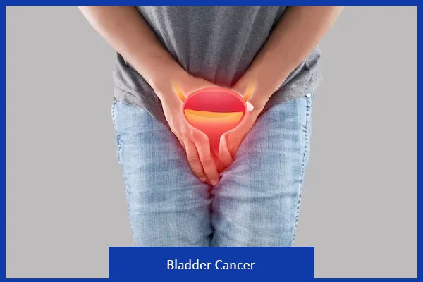Bladder Cancer