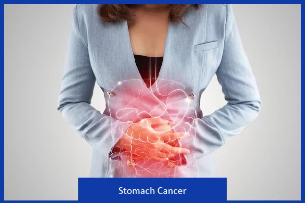 Stomach Cancer