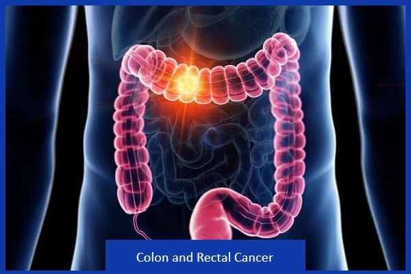 Colon and Rectal Cancer